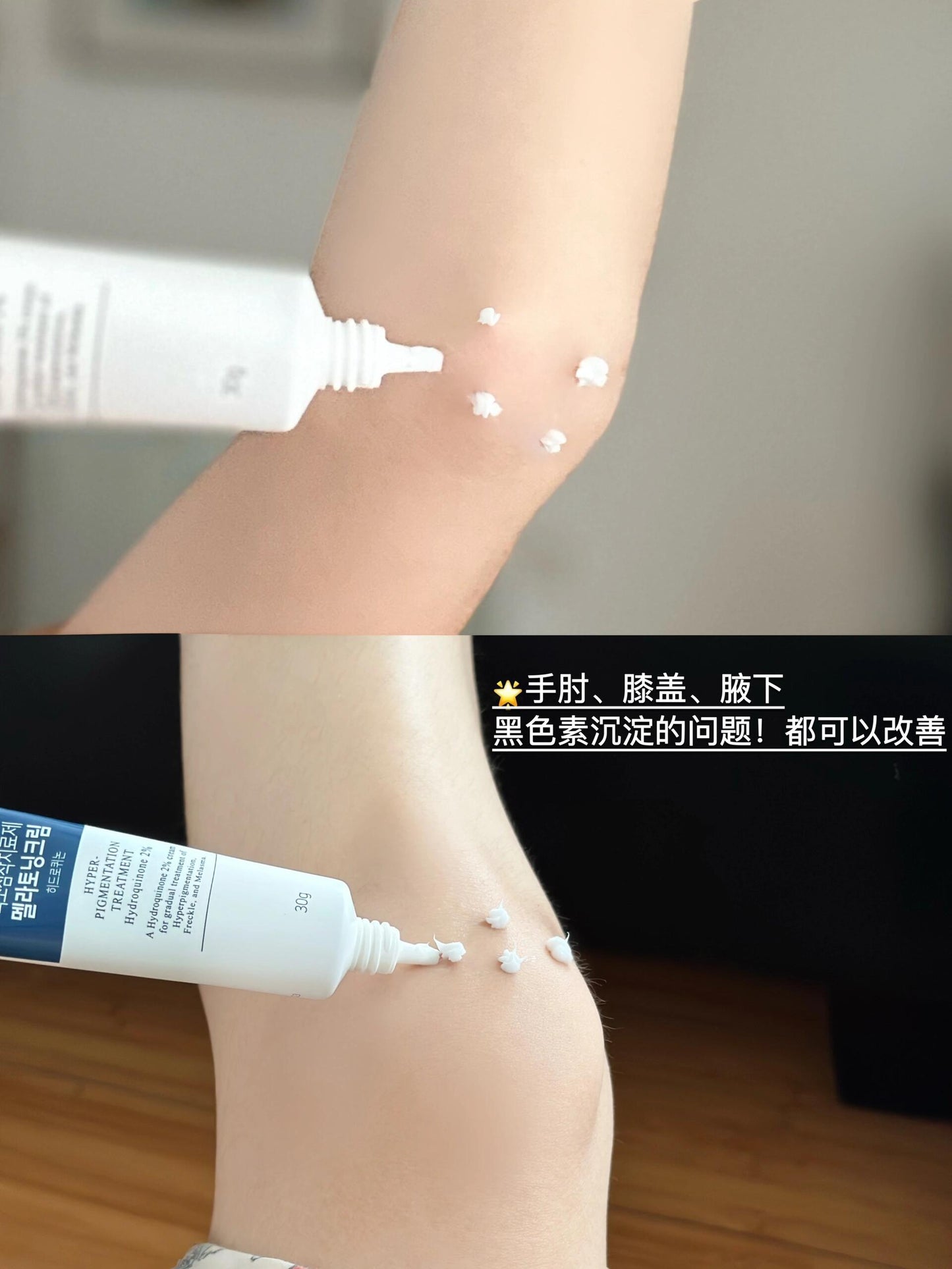 🇰🇷💊淡斑祛斑膏 Melatoning / Melanosa